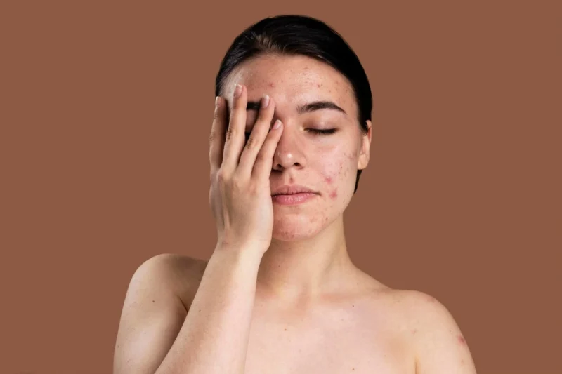 Acne and Acne Scars Treatments