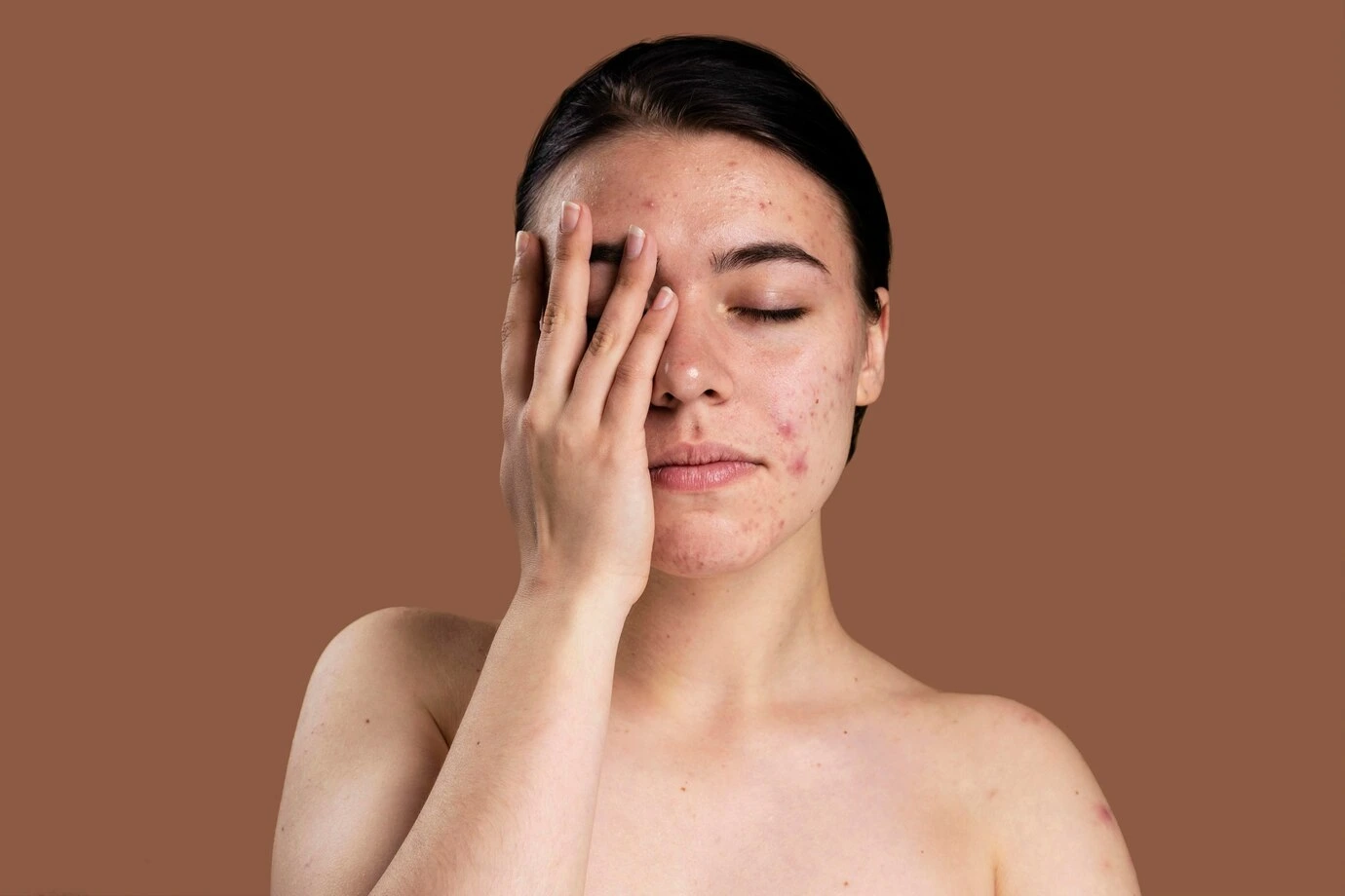 Acne and Acne Scars Treatments