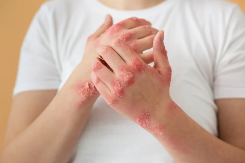 Psoriasis 101: Symptoms, Triggers, and Treatments